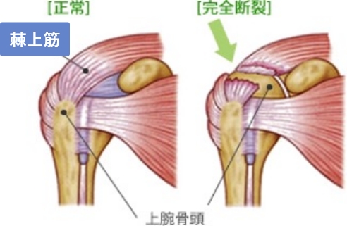 腱板断裂とは？