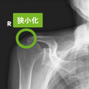 単純X線では肩峰骨頭間距離の狭小化や骨棘形成が見られます。