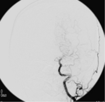 治療前の左側の脳血管撮影像
