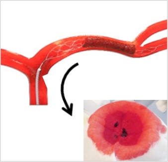 血管内カテーテルのディバイスを用いて、脳血管を閉塞させている血栓を回収