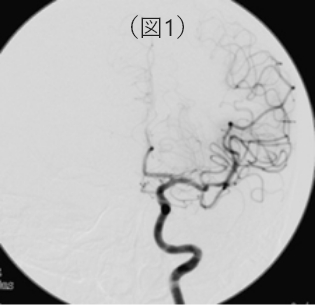 治療後の左側の脳血管撮影像