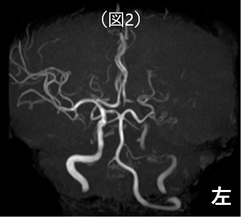 正面からみた脳血管全体像 術前MRA