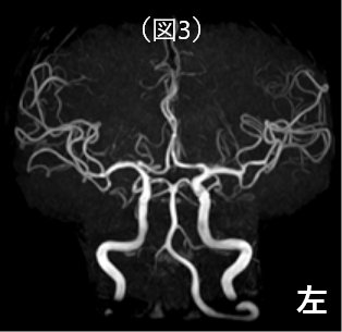 正面からみた脳血管全体像 術後MRA
